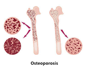 beneficios de la magnetoterapia en osteoporosis y enfermedades óseas