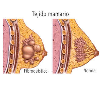 mastopatia fibroquistica sintomas