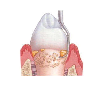 raspado periodontal
