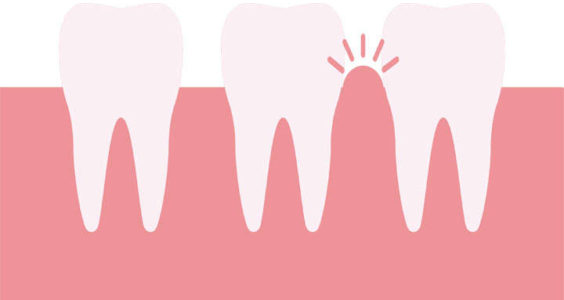 tratamiento periodontal, precios y costes